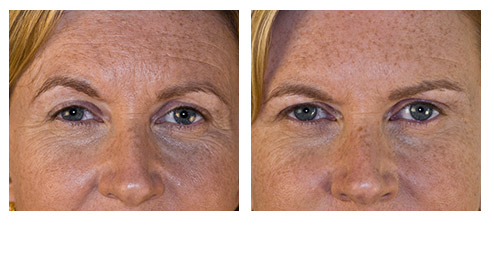 juvederm-01.jpg juvederm-01.jpg